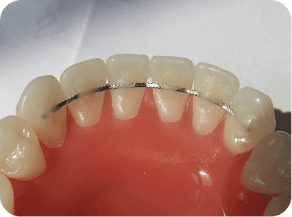Fixed Retainer