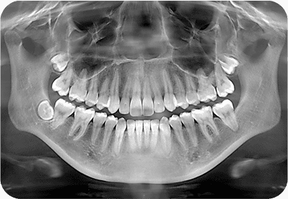 X-rays