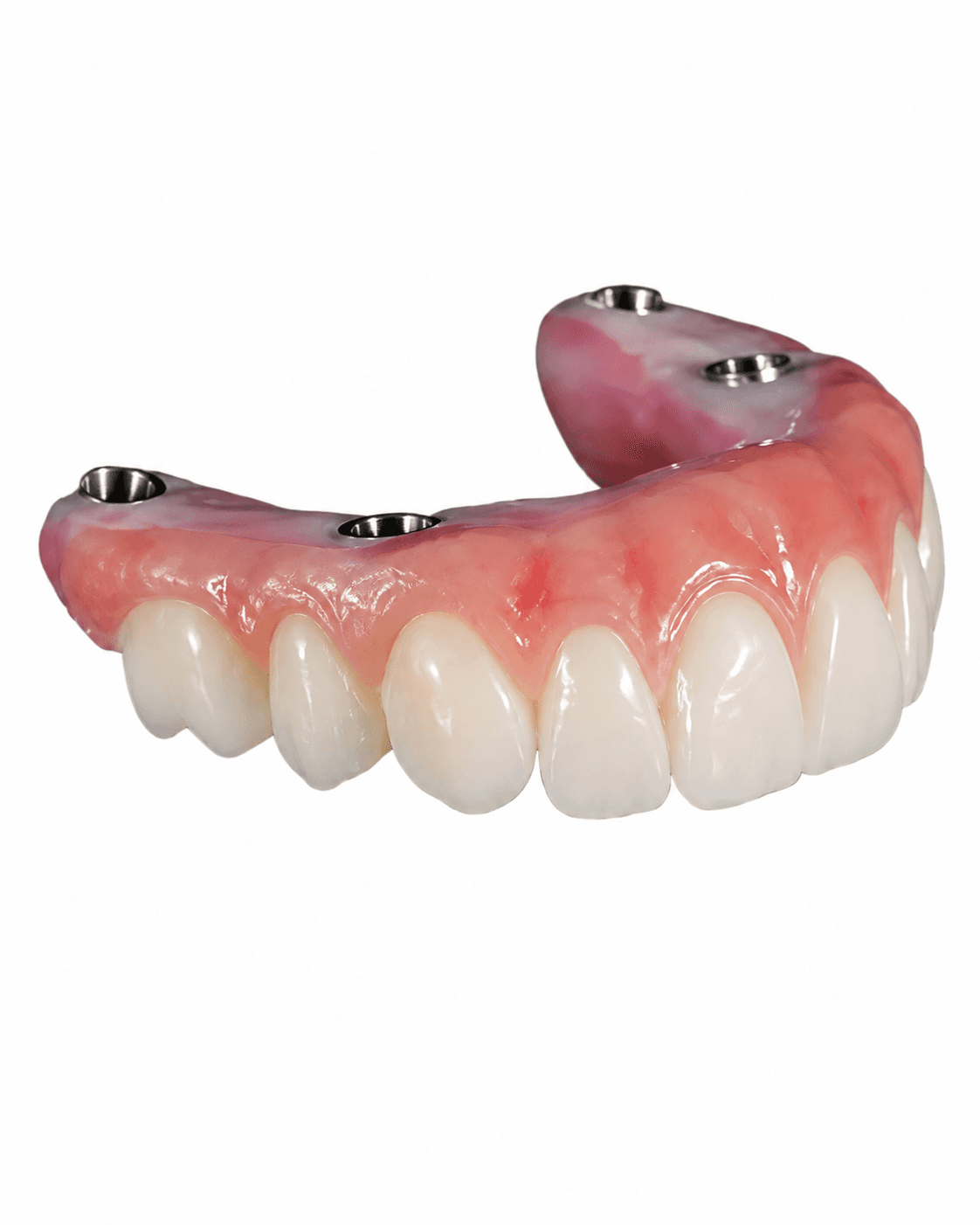 Implant Retained Dentures